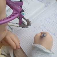 UPDATE 10.07.2025 – Ajut-o pe Elena să ajungă lunar la reglaje în Turcia